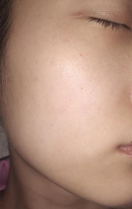 姐妹们知道脸颊两侧这种小疹子是什么吗好像是栗丘疹