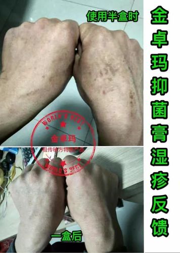 湿疹的分类和症状