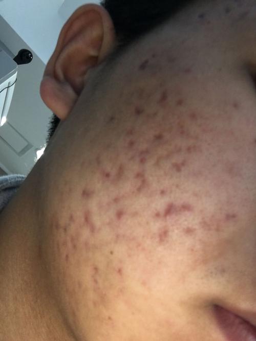 脸上的痘疤怎么除