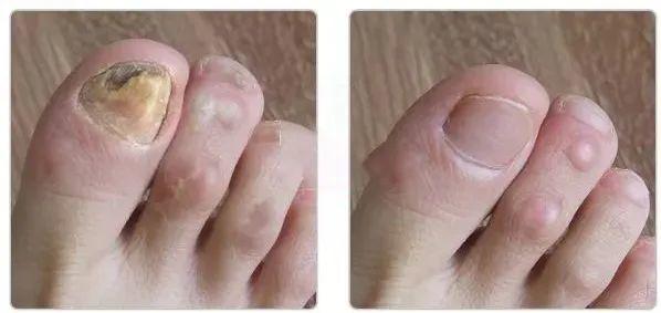 脚上狂起"小水泡",用它抹下,多年脚气全好了!