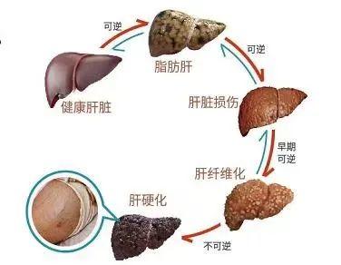 容易被很多人忽视的脂肪肝同样会引起肝炎肝硬化