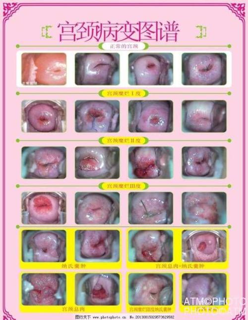 多发纳氏囊肿是什麼呢