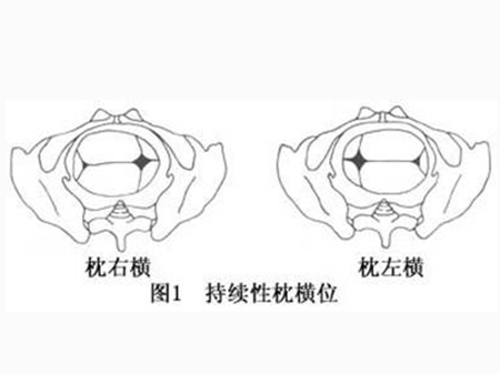 枕横位能顺产吗 能否顺产要因人而异