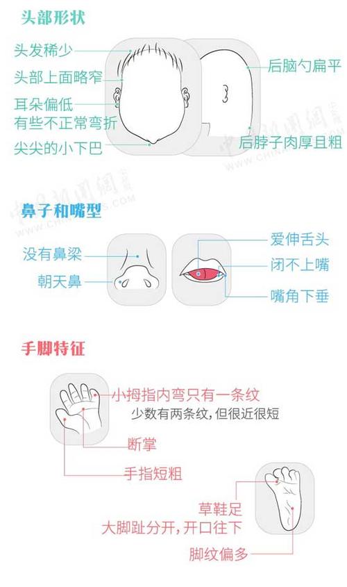 世界唐氏综合征日 一图科普唐氏儿