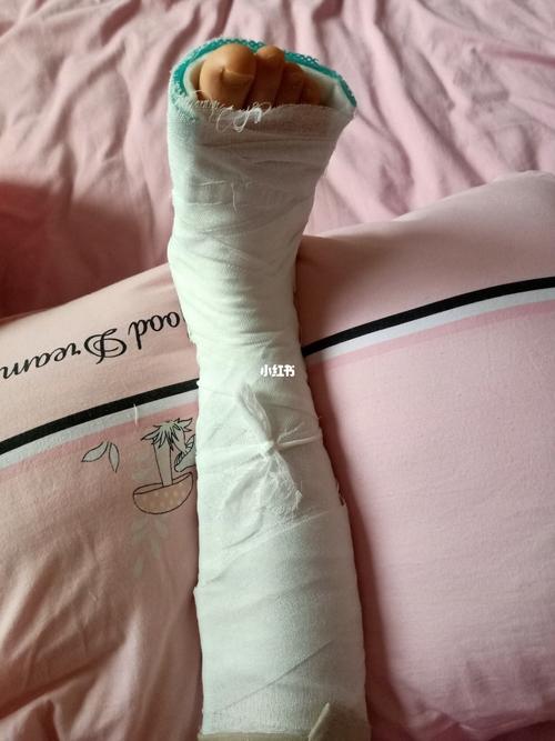 脚跟骨前缘骨折,打了石膏脚指头能动吗_医疗健康_医疗