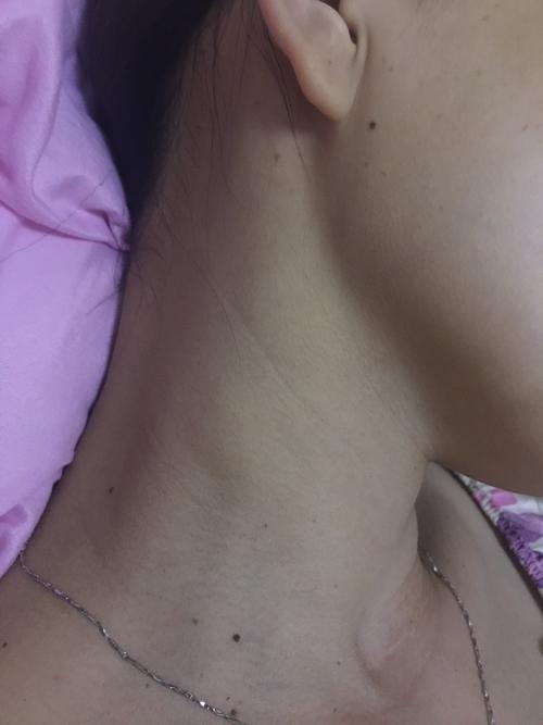 脖子边上鼓起来了一坨 又不痛是什么原因啊