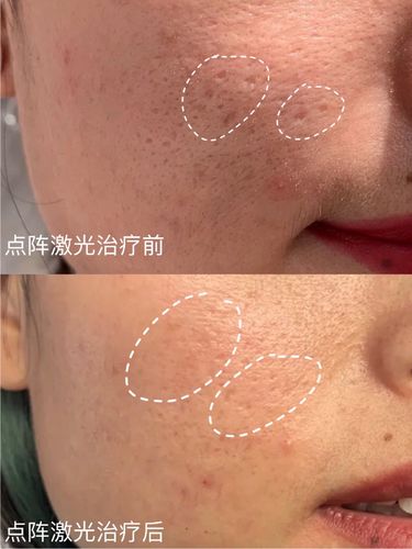 战痘记录点阵激光祛痘真实效果测评