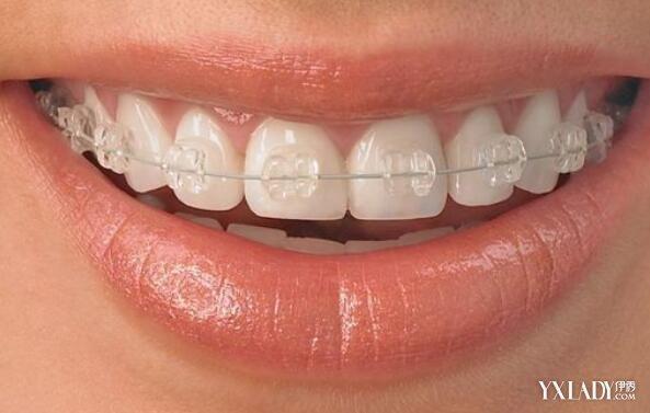 如何让牙齿变整齐 5种矫正方法让你拥有整齐的牙齿