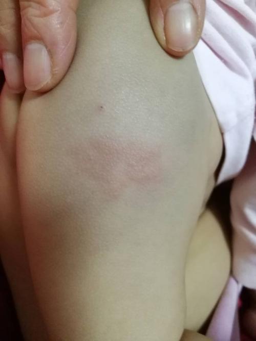 小宝宝一岁七个月打了疫苗,针孔下边起了疙瘩怎么办