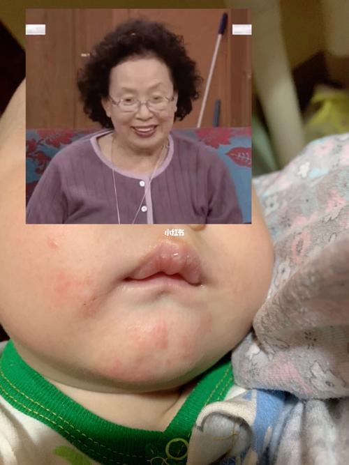 辅食第二天 过敏反应-口水疹_辅食_米粉_母婴_育儿经验