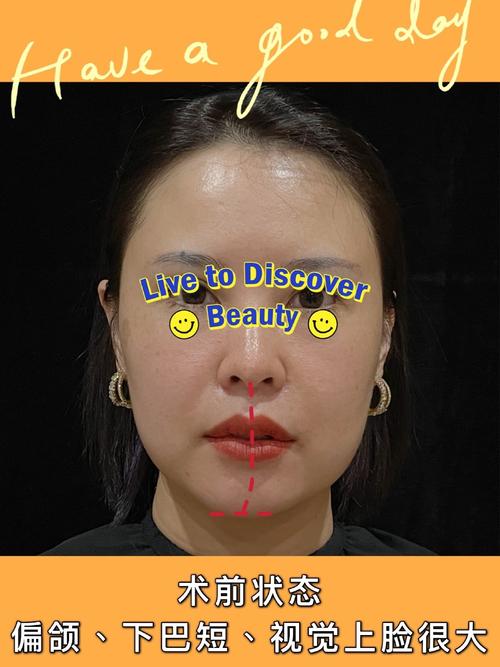 1偏颌,就是俗称的脸歪,自己看肯定是不明显,但是照相或者医生看就很