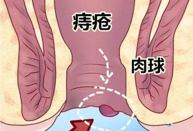 外痔疮必须要割吗肛门外肉球会自己消失吗怎么治疗才靠谱有效