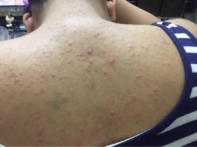 孕七个月前胸后背脸上涨了不少这样的痘痘,宝妈有类似