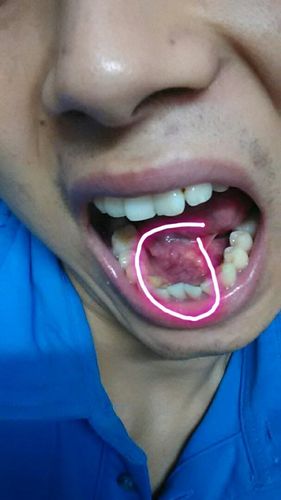 舌系带长了个水泡,我图中标记的那块肉吃饭的时候会变