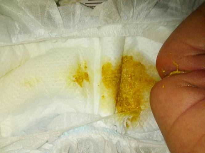 宝宝一天拉十几次大便,这是拉肚子吗?