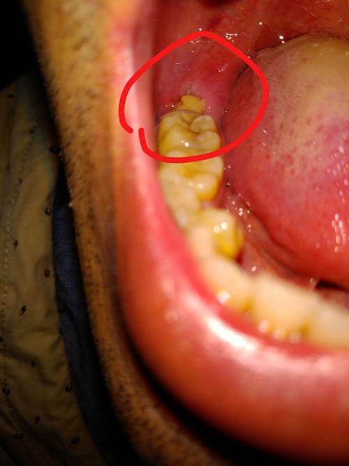 拔完智齿,牙洞有白色的填充物,是食物残渣吗?