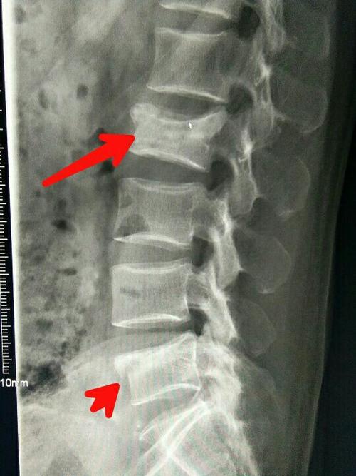 腰2椎体陈旧性压缩性骨折,腰5椎体压缩性骨折