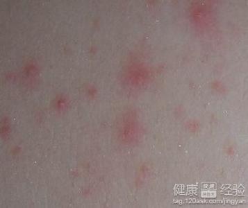 白血病皮肤症状图片