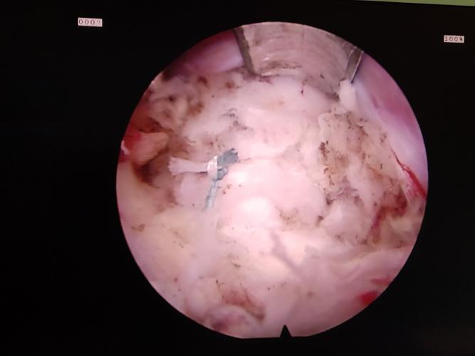 安钢总医院脊柱微创中心首例内镜下纤维环缝合修复术——把腰椎间盘破