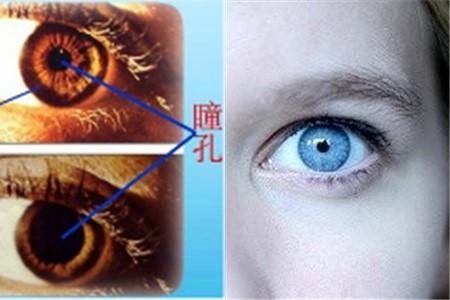 正常瞳孔是圆形,其