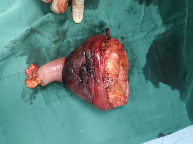 直肠脱垂嵌顿急诊手术