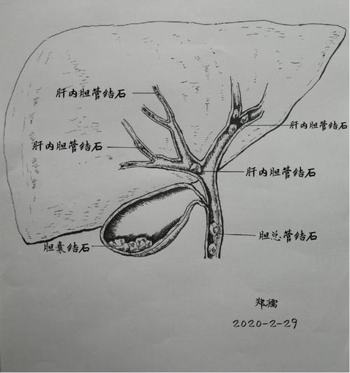 胆管狭窄等原因外很大一部分原因来自今天文章的主角——胆道蛔虫