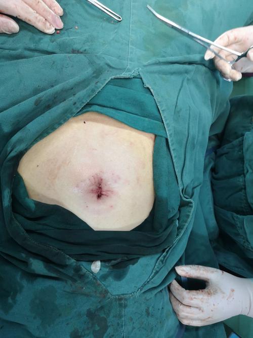 陇西县第一人民医院妇产科成功开展第一例单孔腹腔镜下子宫肌瘤剔除术