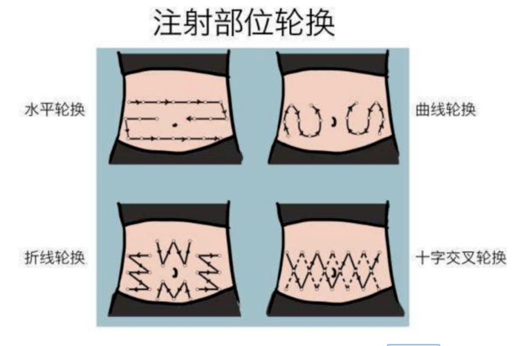 胰岛素皮下注射|小问题,大学问