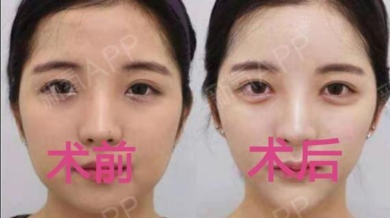 眼袋外切术后三天图片,外切眼袋后多久恢复自然求告知