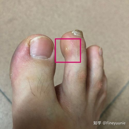 脚趾上长透明疙瘩,中心点像针刺一样的形状