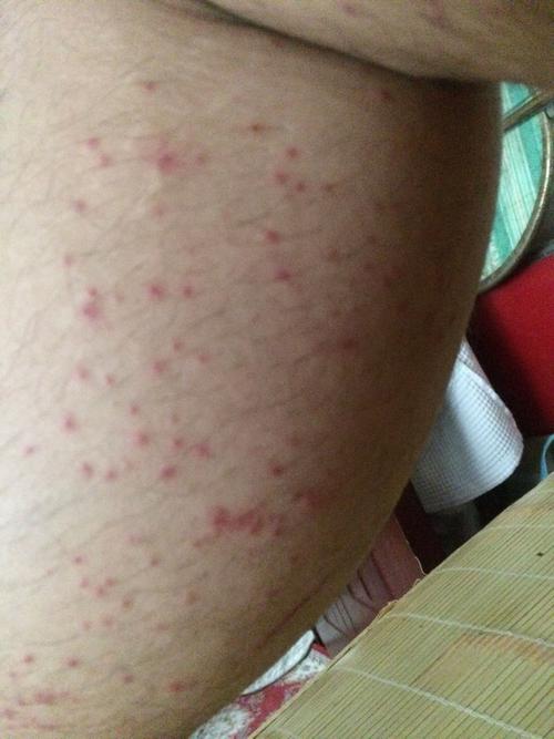 湿疹用痱子粉无效用治疗湿疹的药膏以后不痒了帮忙看看这具体是什么病