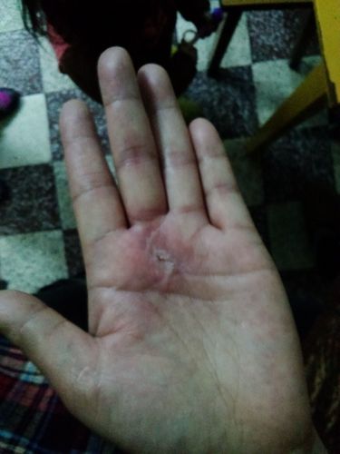 手部腱鞘囊肿,术后手掌伤口处反复开裂.