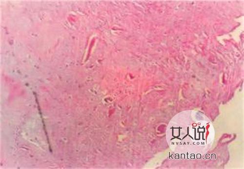 趁早了解滴虫性阴炎的症状,防范!