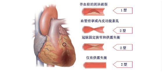 中年人要警惕急性冠脉综合征