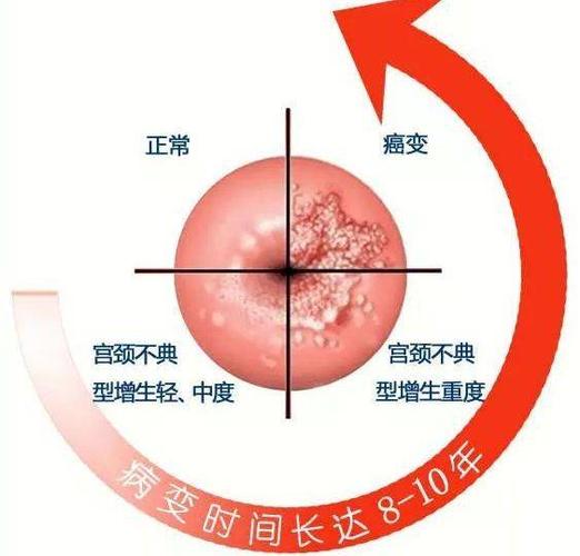 但是从hpv感染那天算起, 癌前病变都会有一些
