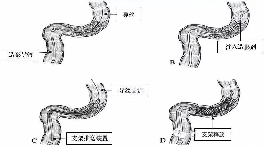 对于肠梗阻,消化内镜医师有神器