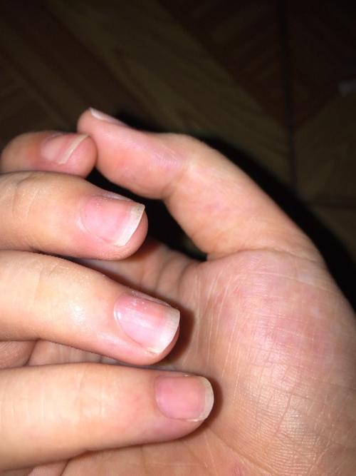 我的无名指的指甲上长有白屑一样的东西,不知道是什么