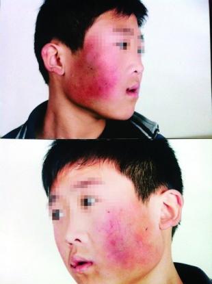 被打学生脸部依然红肿