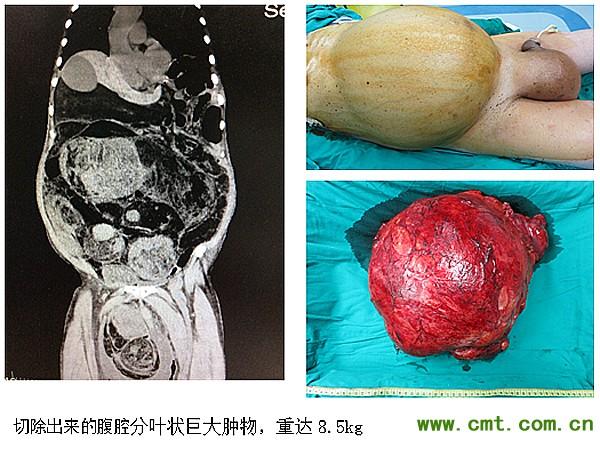 外科为一七旬老人施行了腹膜后巨大肿物切除及阴囊巨大疝内容物切除术