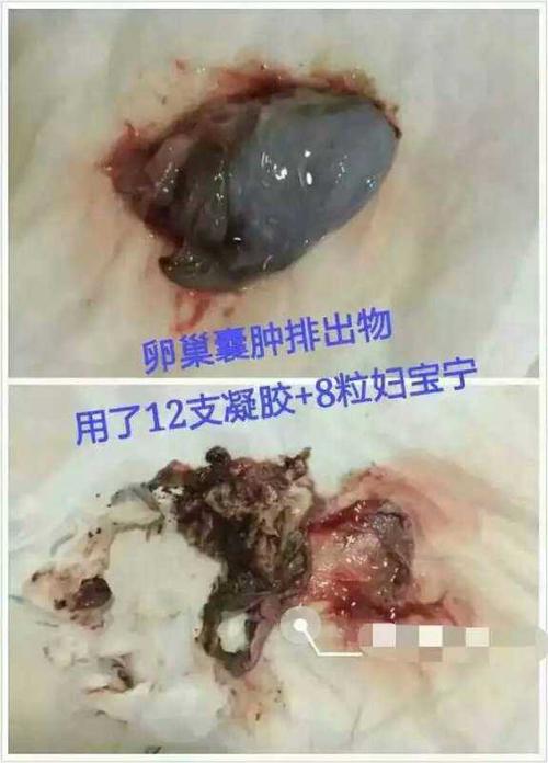 卵巢囊肿太可怕了!排出这么一大堆东西出来(⊙o⊙)
