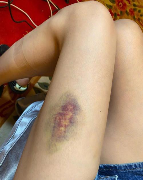 沈梦辰晒大腿淤青照,杨迪火速关切询问,杜海涛良久未现身引调侃
