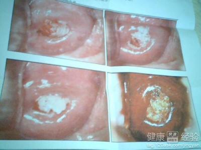 宫颈尖锐湿疣会有什么症状