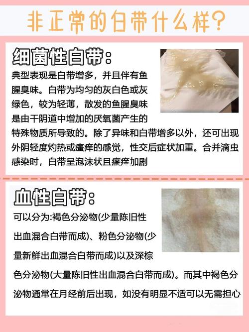 花朵一般的年纪得了细菌性阴噵炎_妇科炎症_性生活_医疗健康_医疗药品