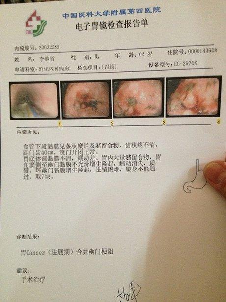 胃癌_360图片