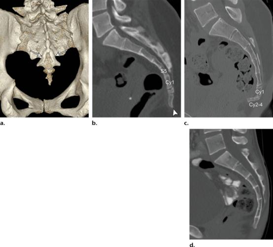 骶尾关节融合及尾骨间关节融合