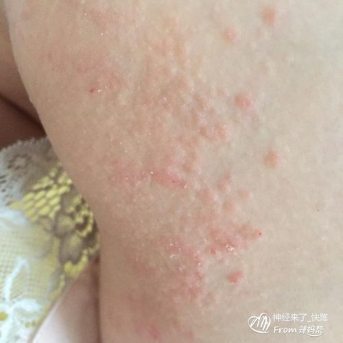 丘疹性荨麻疹和湿疹的看这