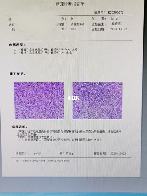 【胃癌晚期抗癌日记】最初的确诊_抗癌_南京市鼓楼医院_抗癌日记_医疗