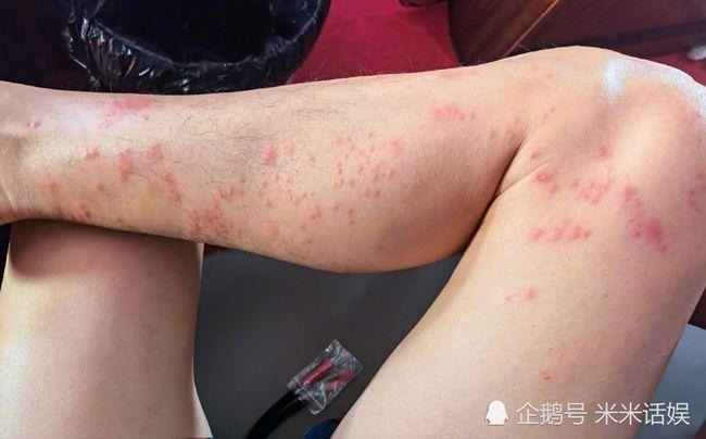 陈学冬下水拍摄被水母蛰伤腿上触目惊心仍旧淡定晒自拍