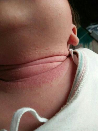 宝宝脸上长得是湿疹还是痱子啊?