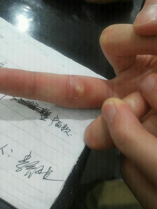 谁知道这是啥东西  昨天洗了下衣服手指肿起很大